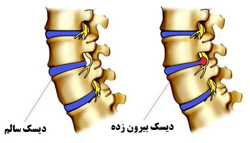 مجله گردشگری دیسک کمر و گردن